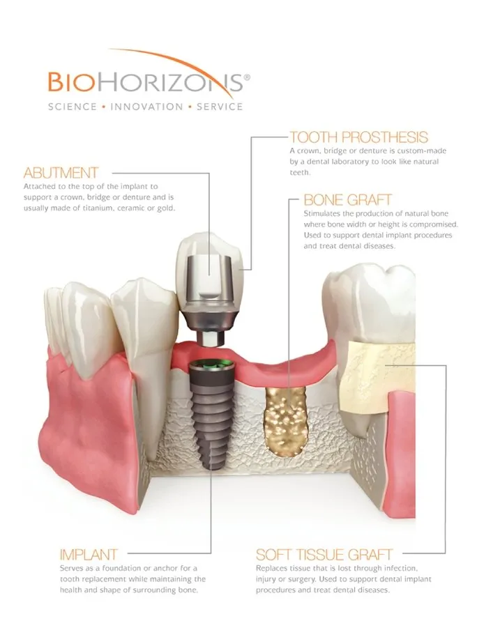 Dental Implants